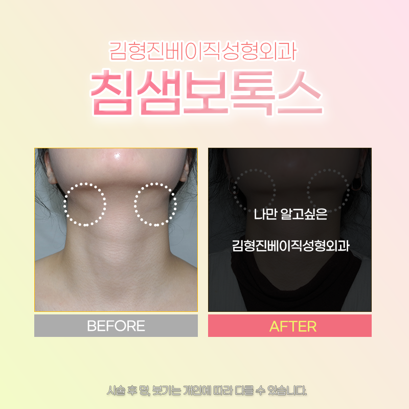 침샘보톡스효과 김형진베이직에서 보셔야죠! 관련 이미지 5