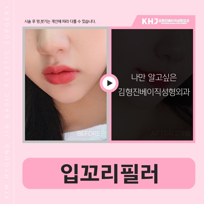 강남입꼬리필러 맛집, 입소문에는 다 이유가 있네요 관련 이미지 6