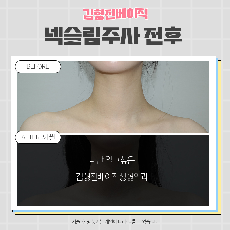 넥슬림보톡스전후 궁금하신분!? 관련 이미지 4