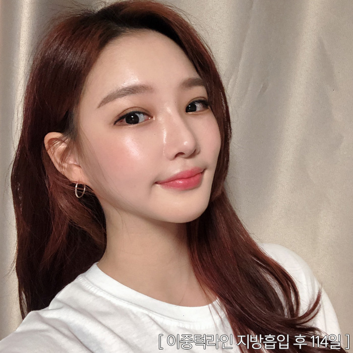 턱지방분해주사 효과 못 보지 않았어요? 관련 이미지 5