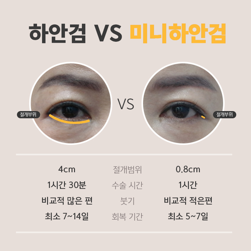 요즘 중년눈밑처짐수술 만족도 1위로 등극한 미니하안검?! 관련 이미지 3