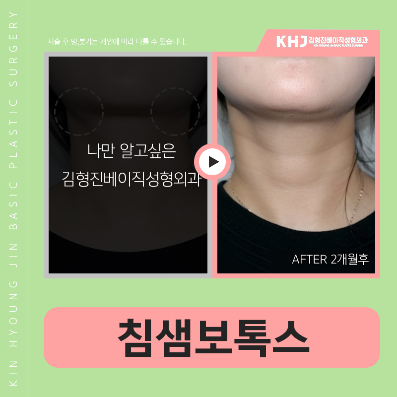 침샘보톡스 하나로 두턱없애기 관련 이미지 4