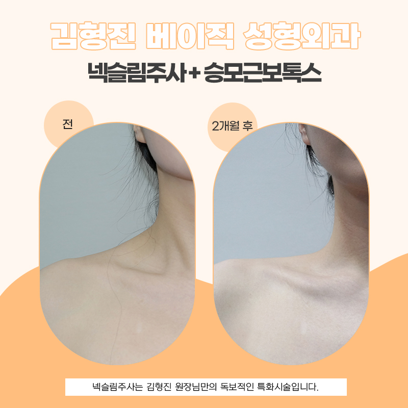 목얇아지는시술 넥슬림주사로 옷핏이 완전 달라졌어요 관련 이미지 5