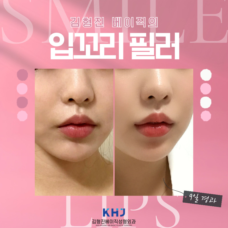 처진입꼬리 한방에 끌어올리는 방법 관련 이미지 5