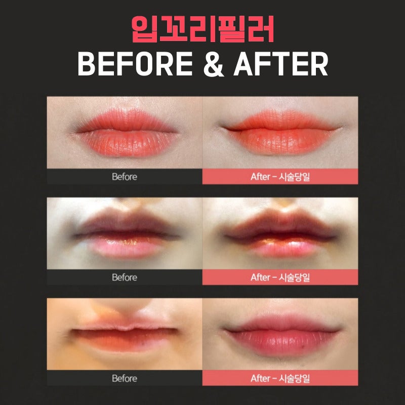 축 처진 입매 교정하는 입꼬리필러시술이 궁금하다면 관련 이미지 6