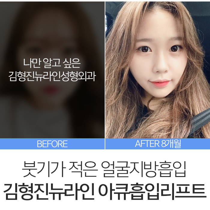 아큐스컬프 붓기 때문에 고민? 관련 이미지 2