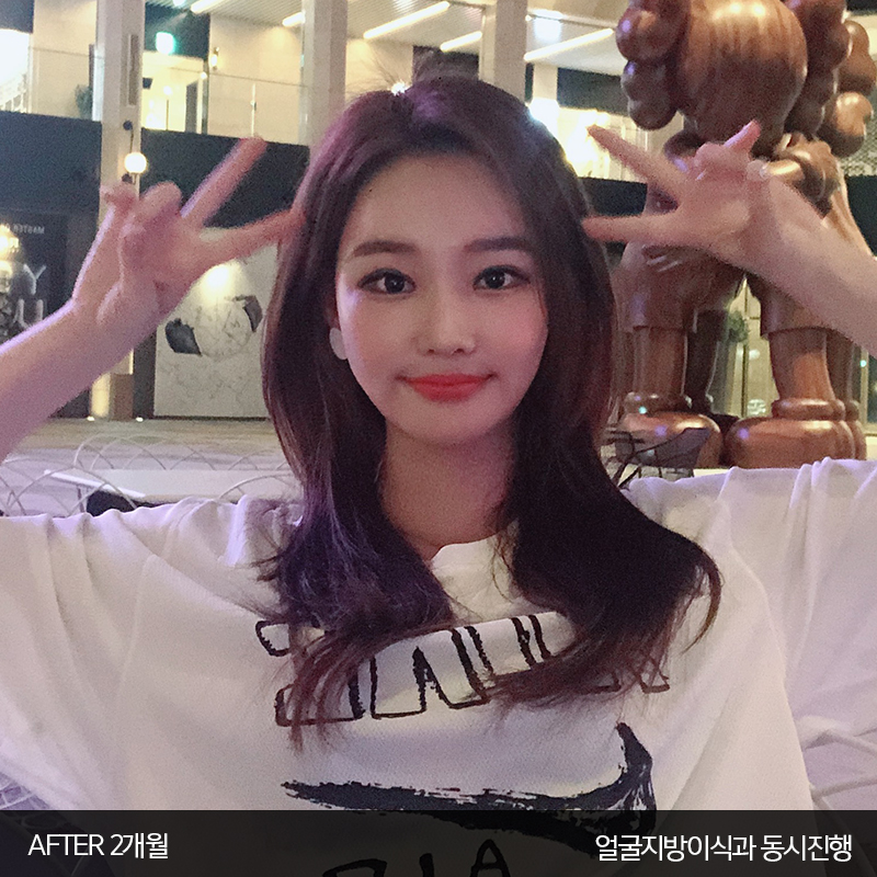 얼굴지흡붓기 김형진베이직은 달라요 관련 이미지 6