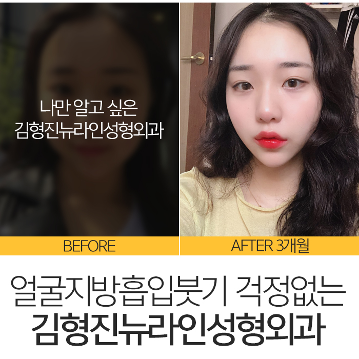 얼굴지방흡입붓기 요즘 누가 걱정해? 관련 이미지 3