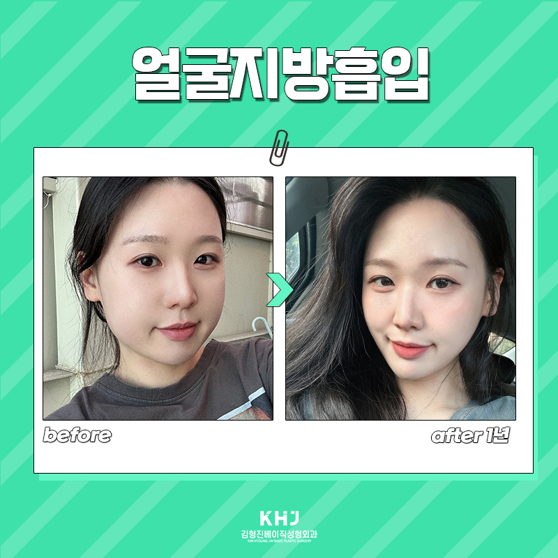 얼굴지방흡입 받고 이미지 변신 제대로 했어요 관련 이미지 6