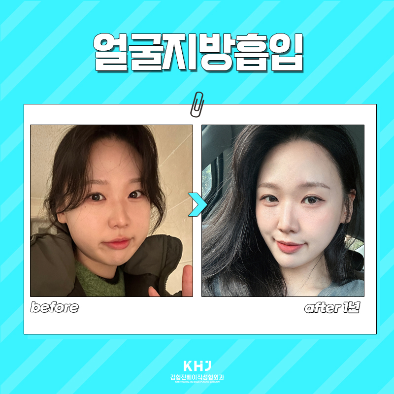 빠지지 않는 얼굴살없애는방법, 궁금하다면 관련 이미지 6