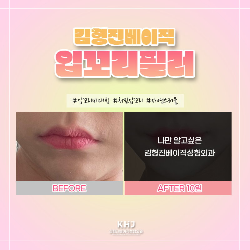입꼬리필러전후 궁금하셨다면? 관련 이미지 5