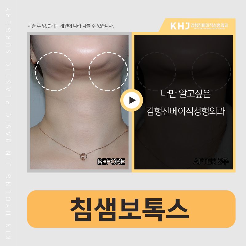 침샘보톡스위치 궁금하시다구요? 관련 이미지 3
