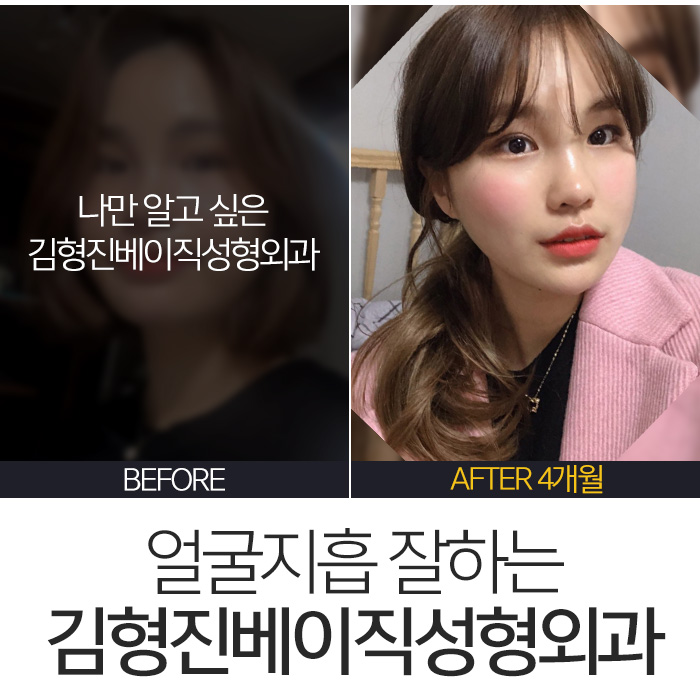김형진베이직얼굴지흡 얼마나 잘하냐면요 관련 이미지 2