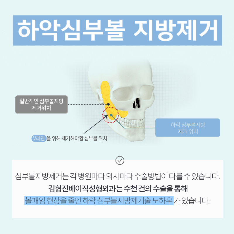 흘러내리는 얼굴살 압구정얼굴지흡으로 뿌시기 관련 이미지 5