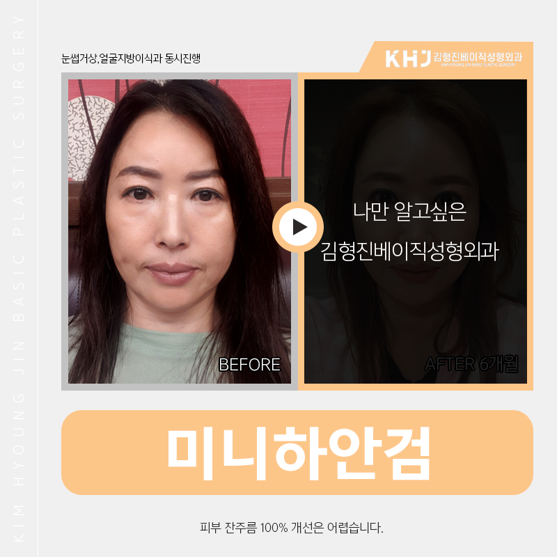 중년눈밑처짐 해결 원하신다면 김형진베이직에서! 관련 이미지 2