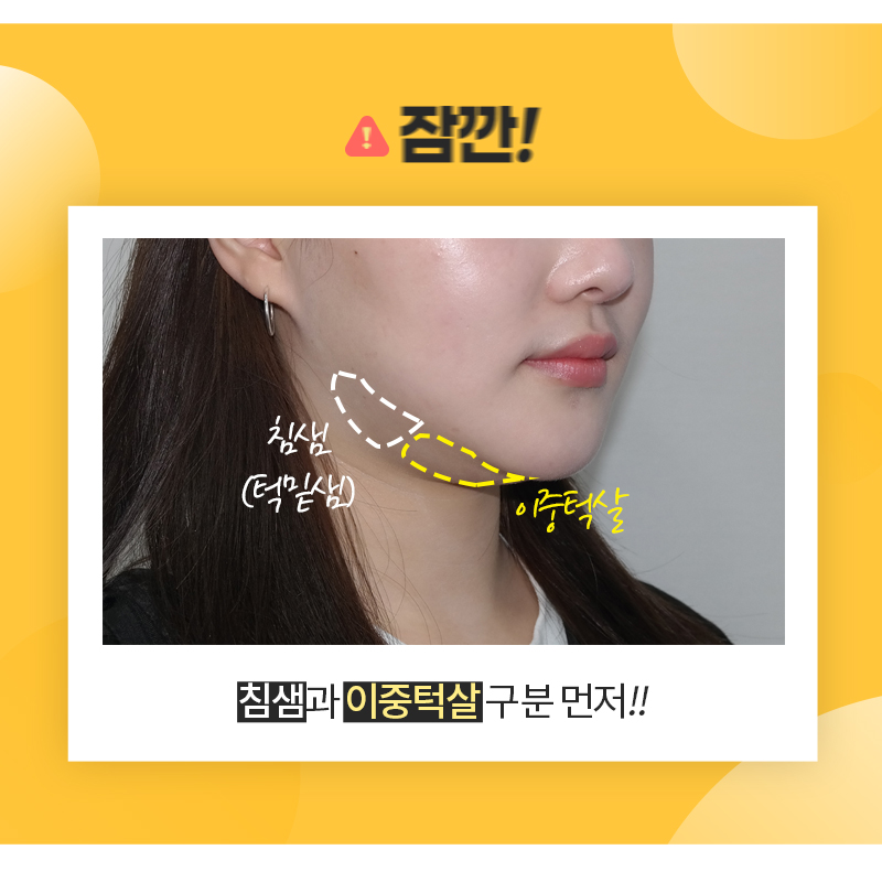 침샘보톡스로 숨어있던 턱선 발견 관련 이미지 5
