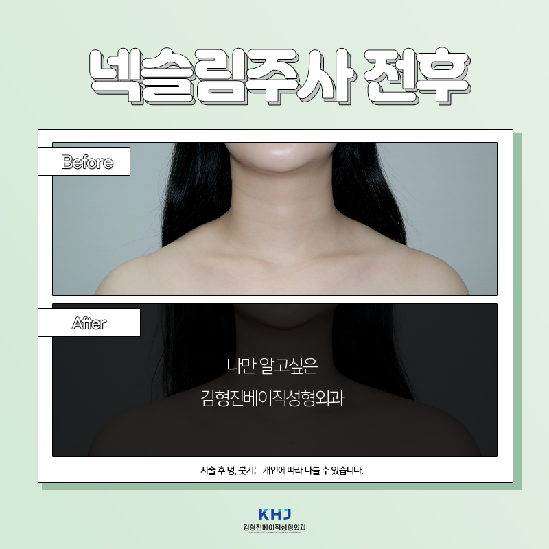넥슬림주사전후 이렇게나 대단해! 관련 이미지 5
