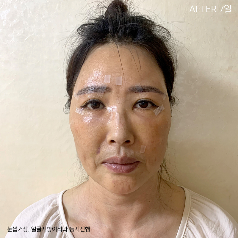 중년눈밑성형 부담없는이유 바로 여기에! 관련 이미지 3