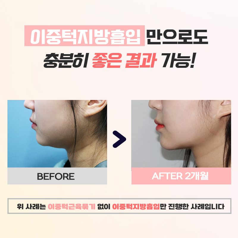 이중턱없애는법 겨우 찾았어요... 관련 이미지 6