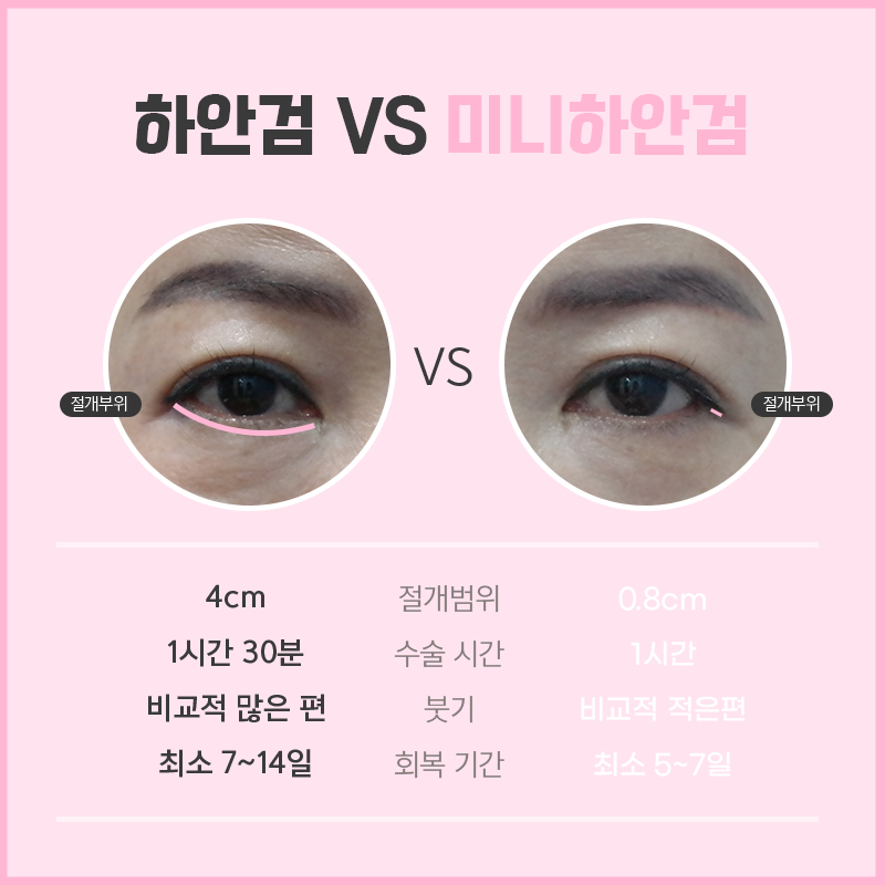 압구정하안검 잘하는 곳 찾고 있다면 관련 이미지 4