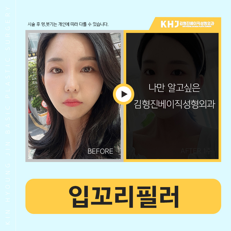 입꼬리필러전후 확실하게 관련 이미지 3