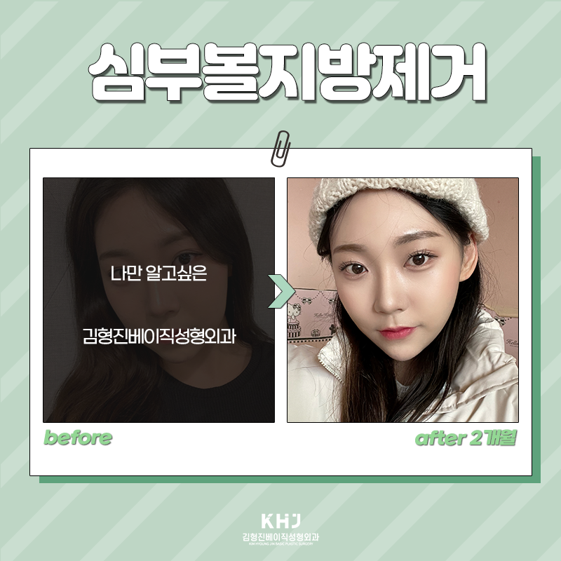 심부볼제거전후 후기 좋은 곳 찾으셨나요? 관련 이미지 5