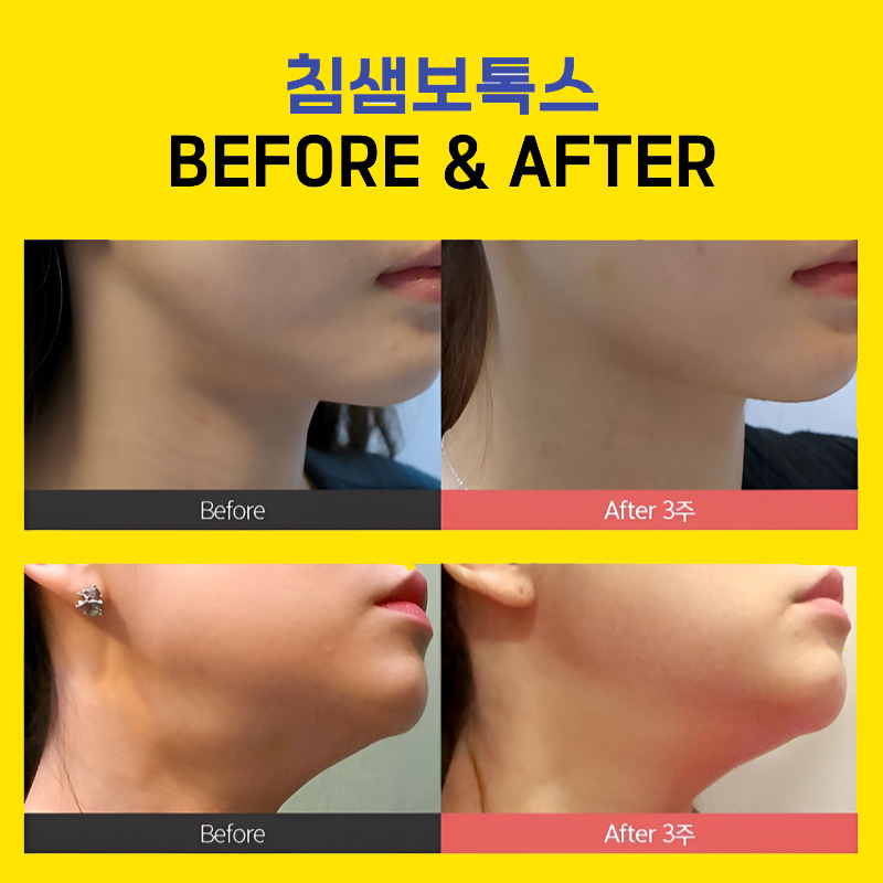 침샘보톡스시술 받고 이중턱에 V라인으로 관련 이미지 6