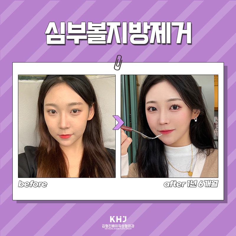 빠르게 볼살빼는법 이것만 알면 쉬워집니다 관련 이미지 6