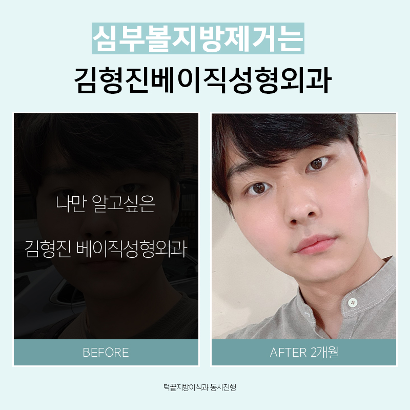 왜 하악심부볼이냐면요. 관련 이미지 7