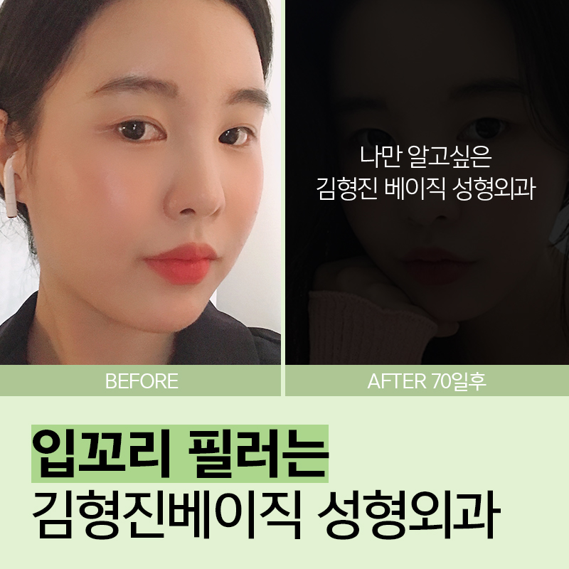 입꼬리필러 맞고 웃상얼굴 되어보기 관련 이미지 3