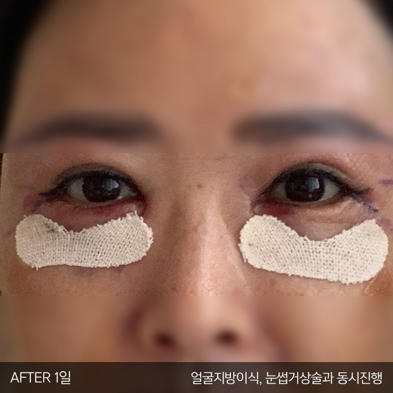 미니하안검수술은 김형진베이직이죠 관련 이미지 3