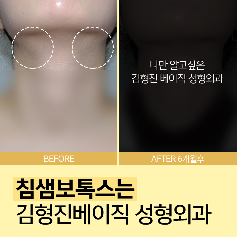 침샘보톡스로 숨어있던 턱선 발견 관련 이미지 3
