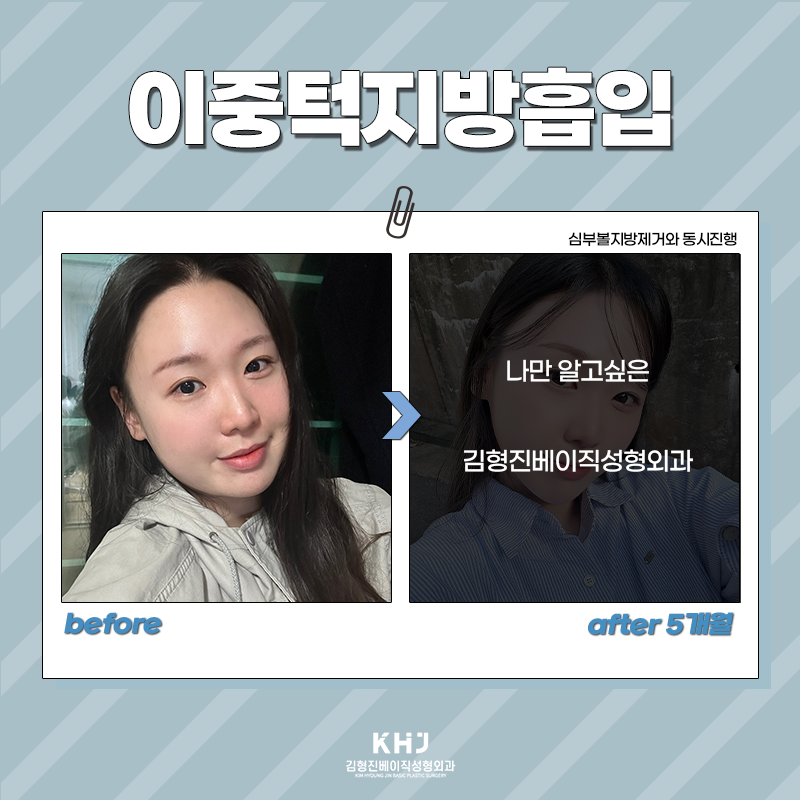 날렵한턱선 가지고 싶다면? 관련 이미지 5