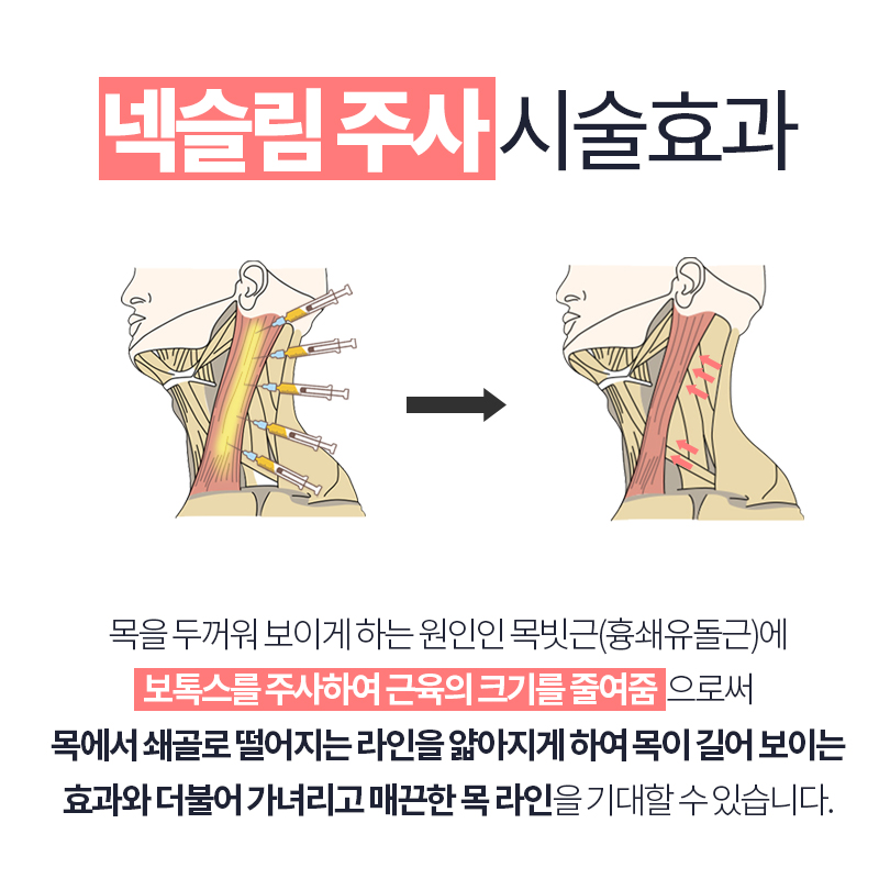 두꺼운목선, 과연 갸름해질 수 있을까? 관련 이미지 4