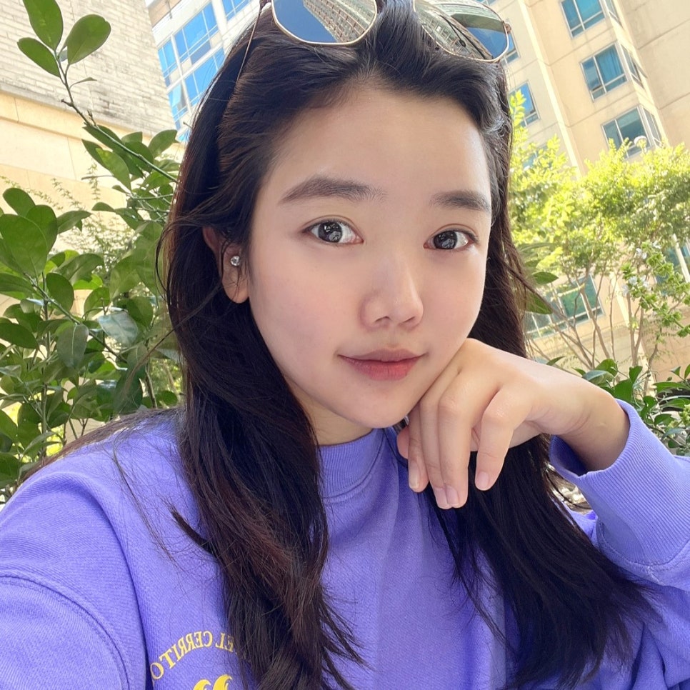 울룩불룩한 눈 밑, 눈밑지방재배치수술로 해결했어요 관련 이미지 2