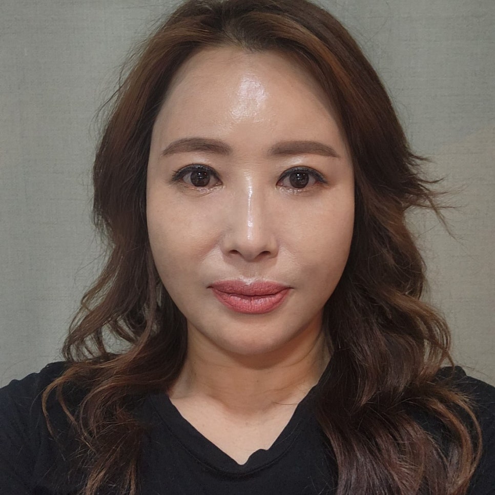중년눈성형후기 눈 밑이 달라지니까 인상이 확 바뀌었어요 관련 이미지 1
