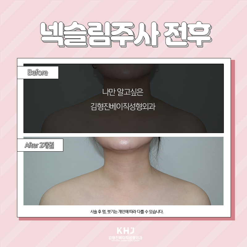 두꺼운목 고민이시라면 김형진베이직으로! 관련 이미지 5