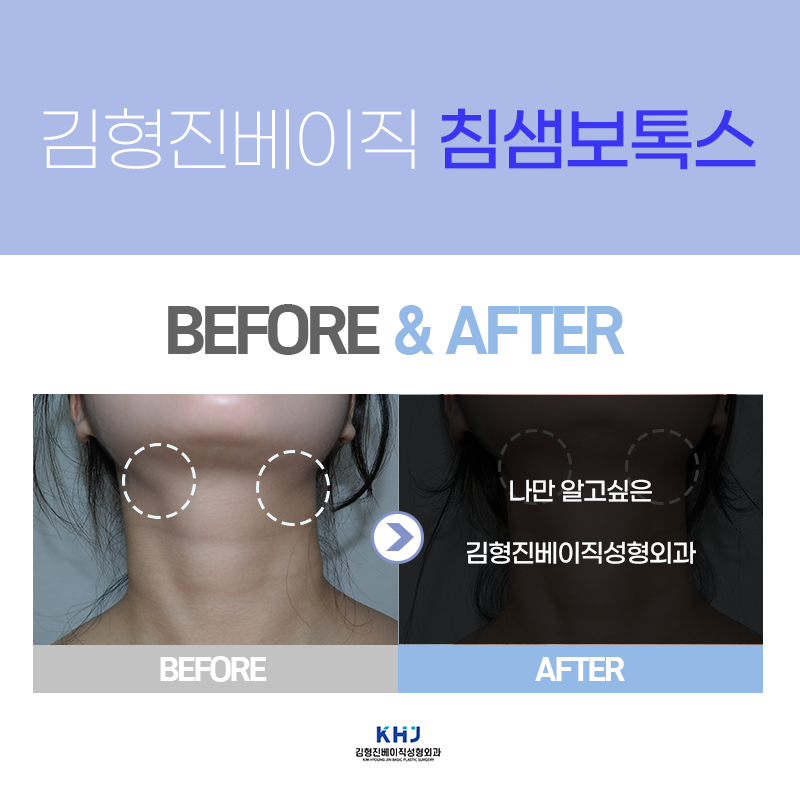 침샘보톡스전후 궁금하시다구요? 관련 이미지 5