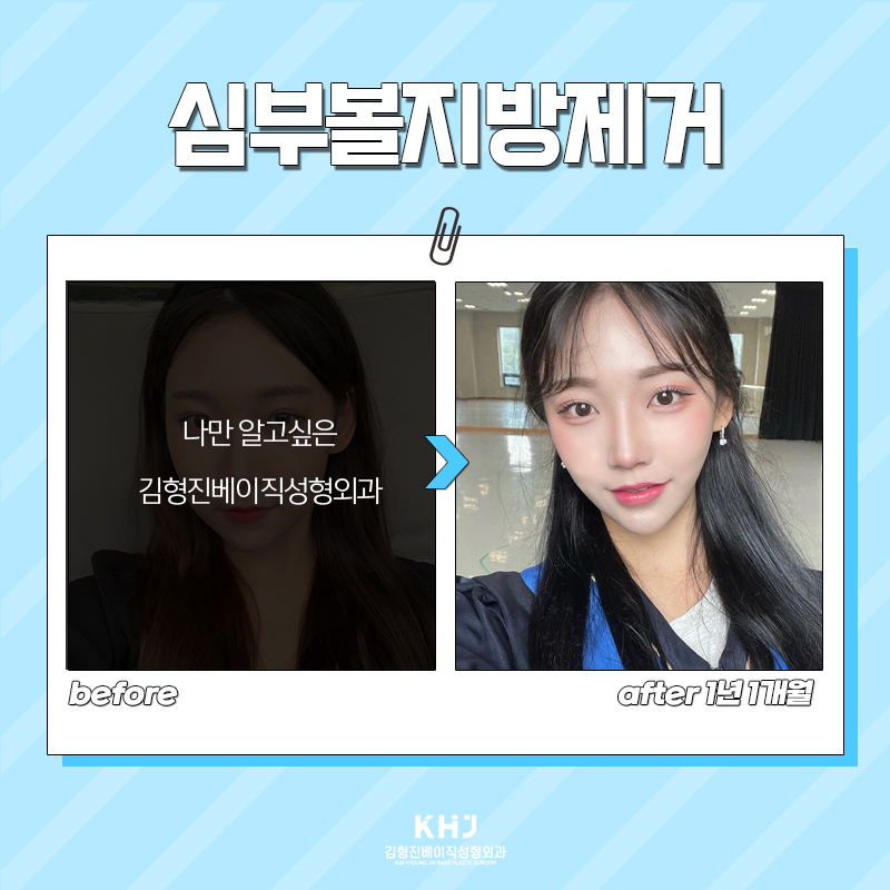 아직도 심부볼지방없애는법 고민하고 계신다면? 관련 이미지 6