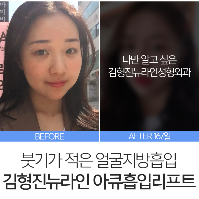 아큐스컬프 붓기 때문에 고민? 관련 이미지 7