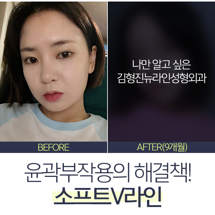 윤곽부작용 해결책 있어요 있어! 관련 이미지 3
