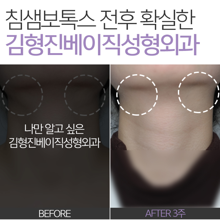 침샘보톡스전후 차이, 보이세요? 관련 이미지 3