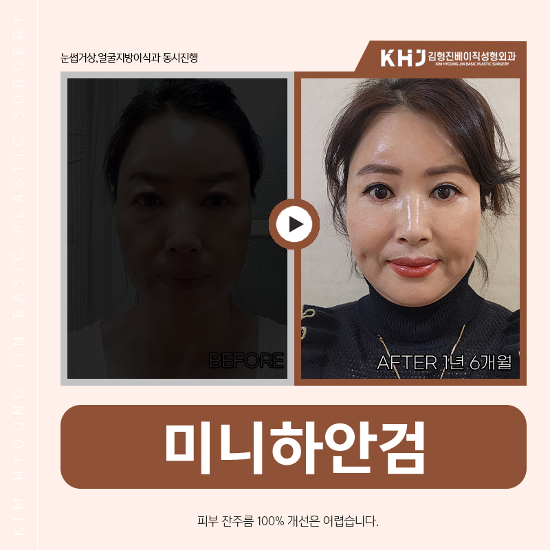 Solving Under-Eye Surgery for Middle Age with Mini Lower Blepharoplasty! image 6