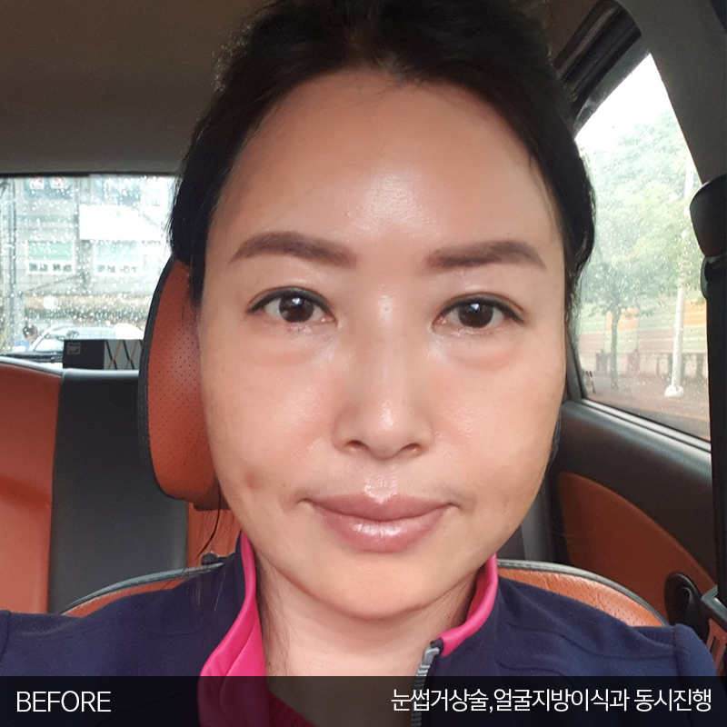 중년눈밑수술 잘하는 김형진베이직 관련 이미지 2