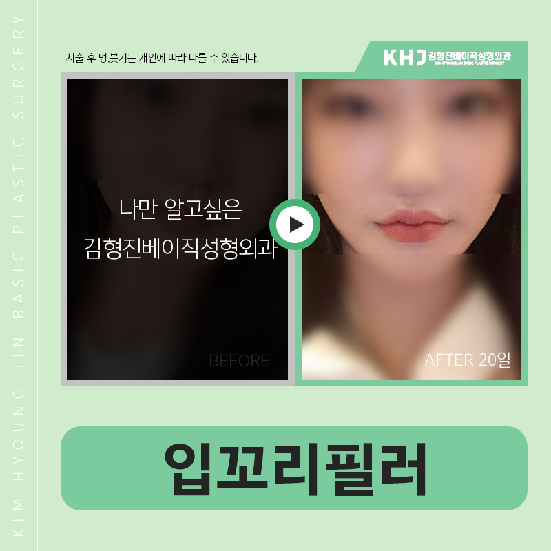 입꼬리필러효과 아직도 모르셨다면 클릭! 관련 이미지 6