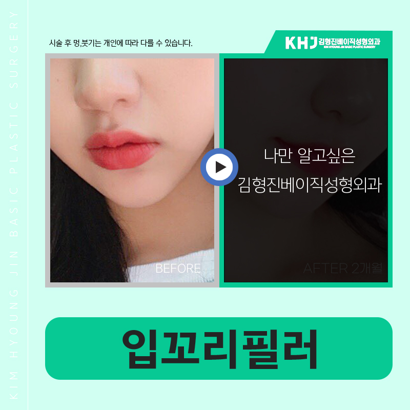 You can create more vibrant lips with just a mouth-corner filler procedure! image 5