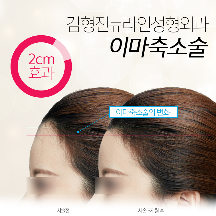 이마좁아지는법 중요한 포인트만 쏙~! 관련 이미지 3