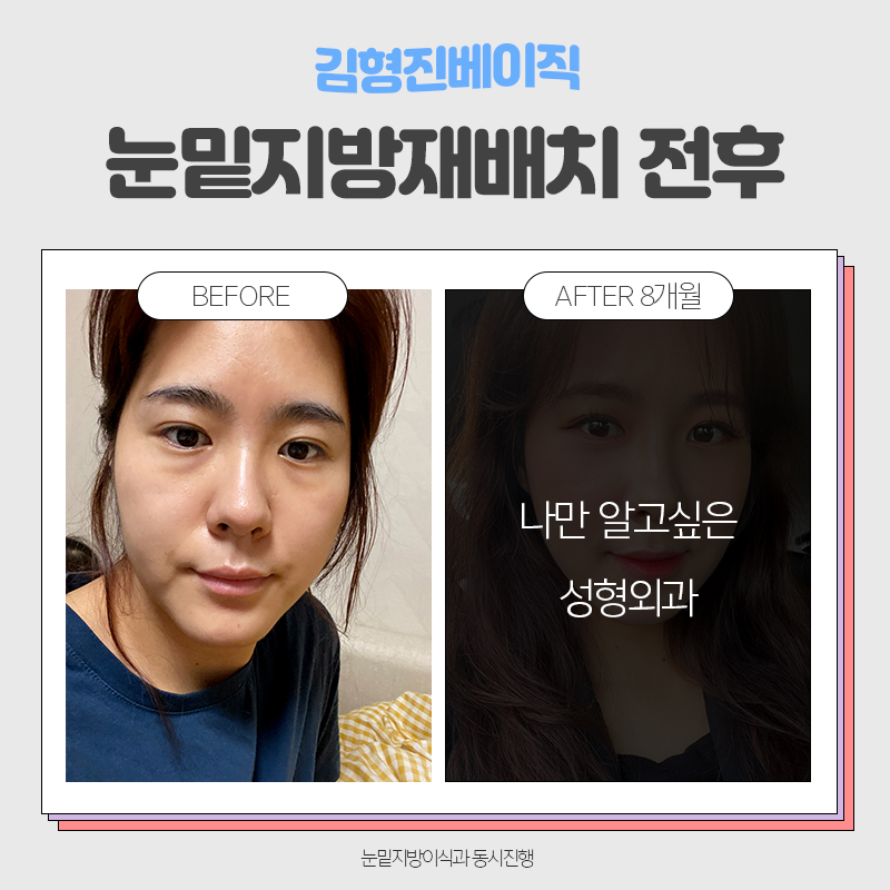 눈밑지방재배치전후 보러오실분 관련 이미지 6
