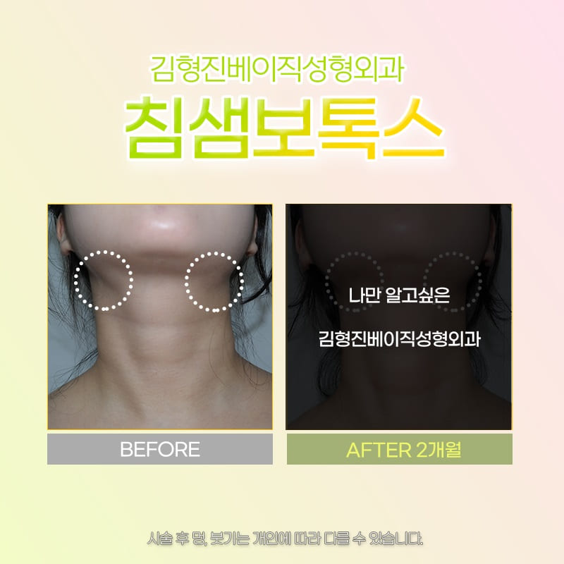 침샘비대증 치료하고 날렵한 턱선 만들었어요! 관련 이미지 5