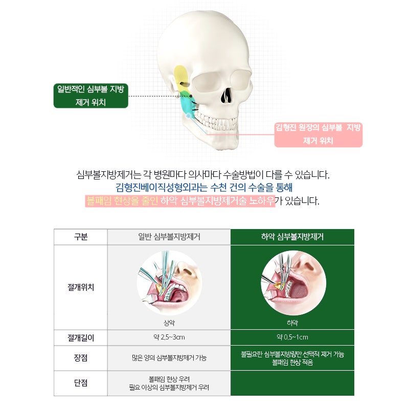 압구정심부볼지방제거로 얼굴형 망치는 원인 너무 쉽게 해결! 관련 이미지 3